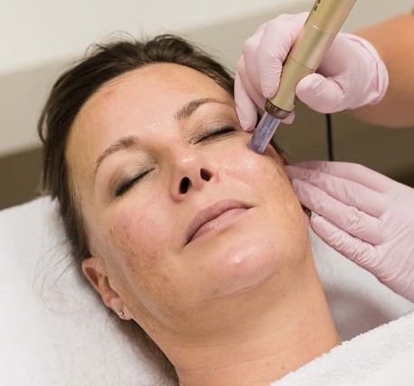 Microneedling Intense 2:00